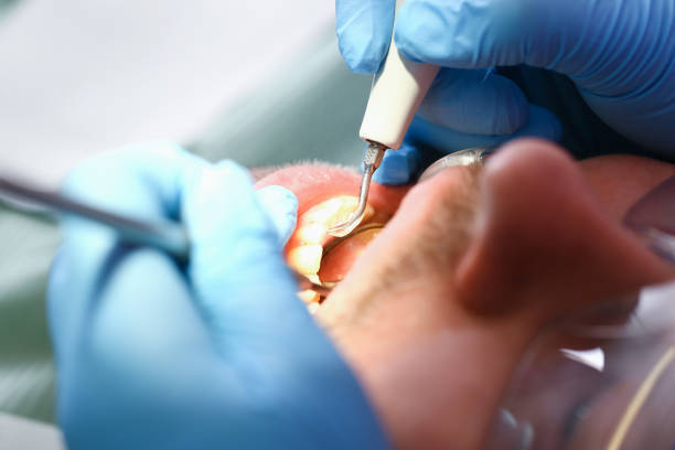 Best Emergency Tooth Extraction in Southgate, FL